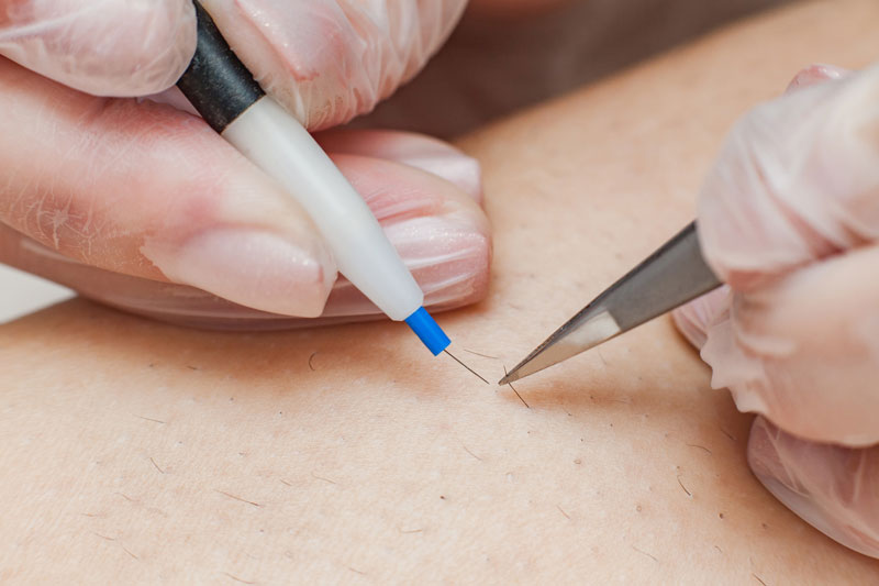 electrolyse epiliation